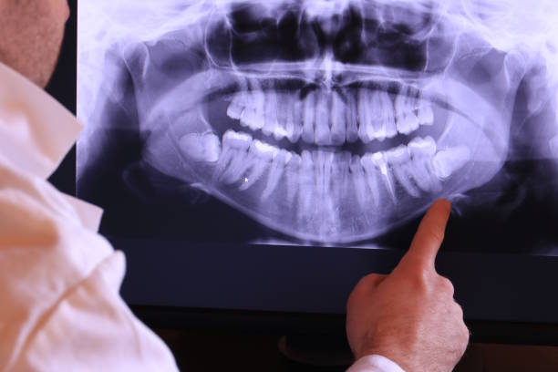 Best Emergency Wisdom Teeth Removal in Marion, SC